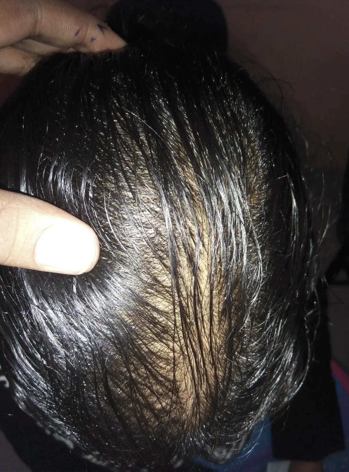Female Pattern Baldness case 1 after treatment